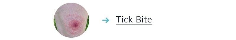 Get Tick Bite Treatment